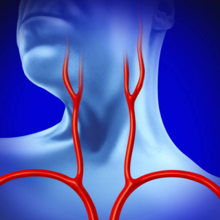 2026 NCH Update on Management of Asymptomatic Carotid Disease Banner